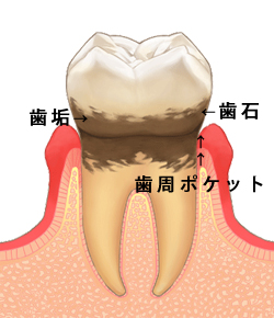 歯周病の歯